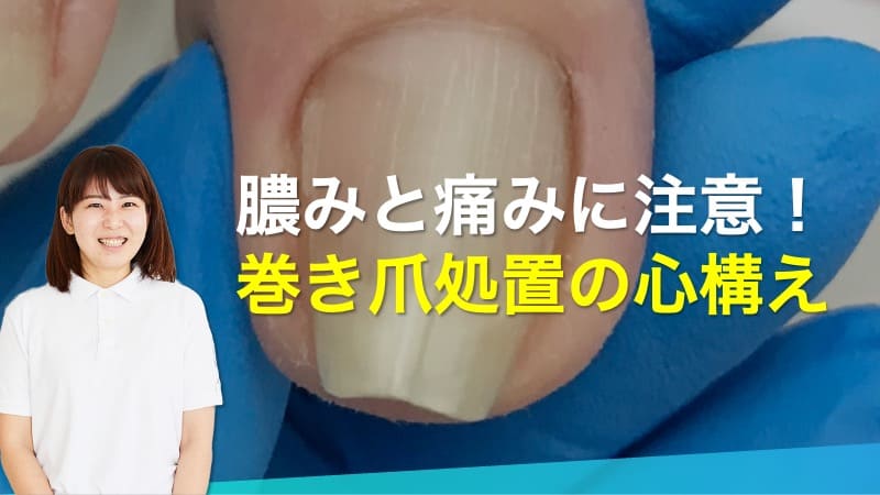 膿みと痛みに注意！巻き爪処置の心構え