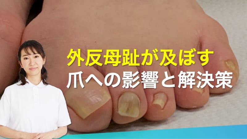 外反母趾が及ぼす爪への影響と解決策